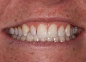 Clear Aligners