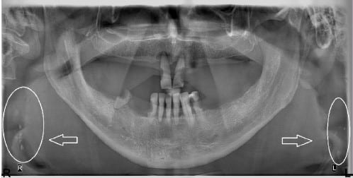 Pan carotid